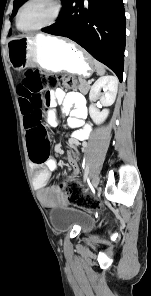 Chronic small bowel volvulus (Radiopaedia 75224-86322 C 54).jpg