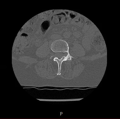 Chronic spinal hematoma with cauda equina syndrome (Radiopaedia 75745-88197 Axial bone window 32).png