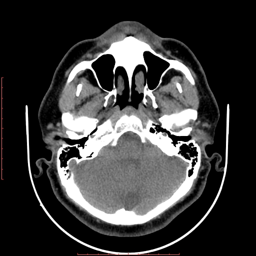Chronic submandibular sialolithiasis (Radiopaedia 69817-79814 Axial non-contrast 10).jpg