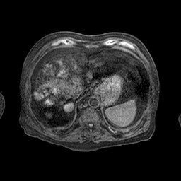 Cirrhosis and hepatocellular carcinoma in the setting of hemochromatosis (Radiopaedia 75394-86594 Axial T1 C+ fat sat 57).jpg