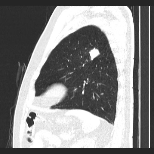 Classic complicated silicosis (Radiopaedia 49720-54961 Sagittal lung window 15).jpg