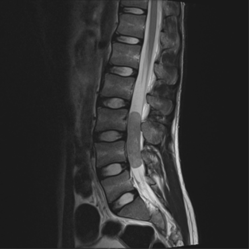 File:Clear cell meningoma - lumbar spine (Radiopaedia 60116-67690 Sagittal T2 8).png