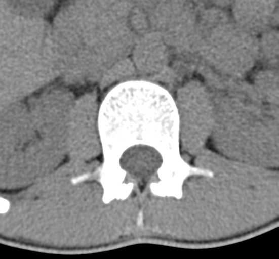 Clear cell meningoma - lumbar spine (Radiopaedia 60116-67691 Axial non-contrast 13).png