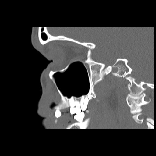 Cleft hard palate and alveolus (Radiopaedia 63180-71710 Sagittal bone window 33).jpg