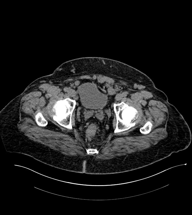 Closed-loop small bowel obstruction-internal hernia (Radiopaedia 78439-91096 Axial non-contrast 144).jpg