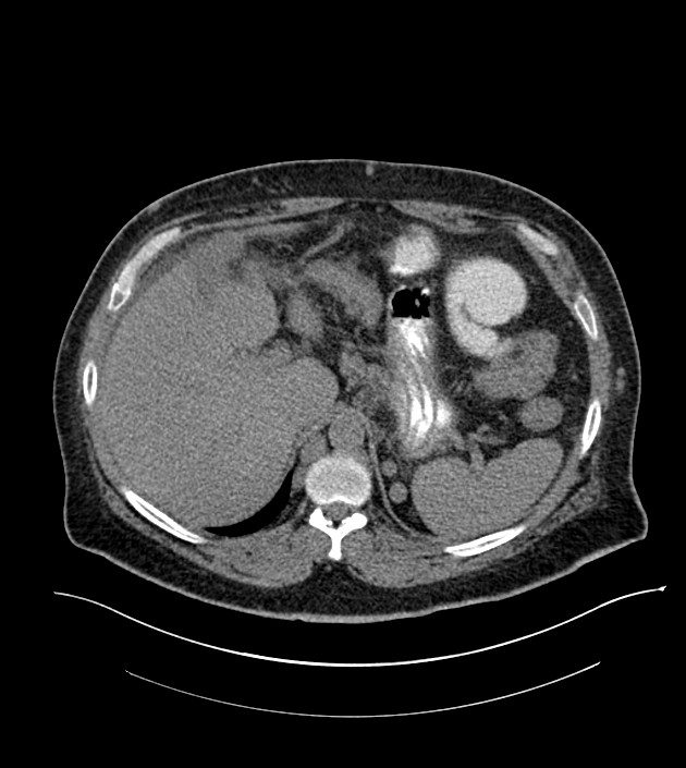 Closed-loop small bowel obstruction-internal hernia (Radiopaedia 78439-91096 Axial non-contrast 36).jpg