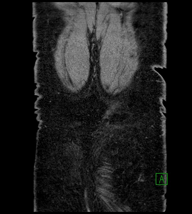 Closed-loop small bowel obstruction-internal hernia (Radiopaedia 78439-91096 Coronal non-contrast 97).jpg