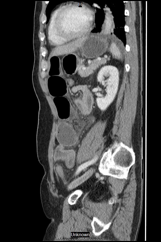 Closed loop bowel obstruction and ischemia (Radiopaedia 86959-103180 C 19).jpg