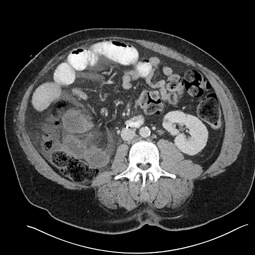 File:Closed loop obstruction - internal hernia into nephrectomy bed (Radiopaedia 59867-67320 Axial 2).jpg