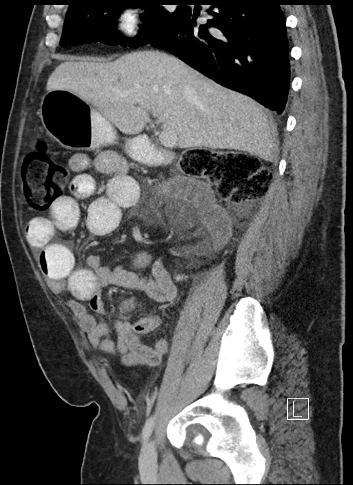Closed loop obstruction - internal hernia into nephrectomy bed (Radiopaedia 59867-67320 C 65).jpg