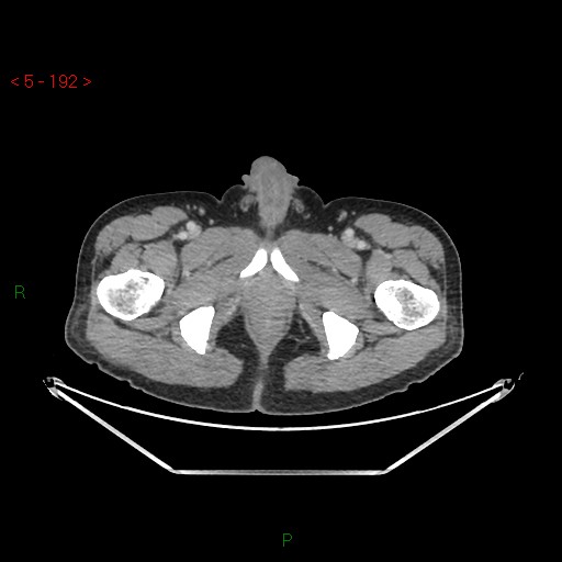 File:Closed loop obstruction and appendicular stump mucocele (Radiopaedia 54014-61158 A 86).jpg