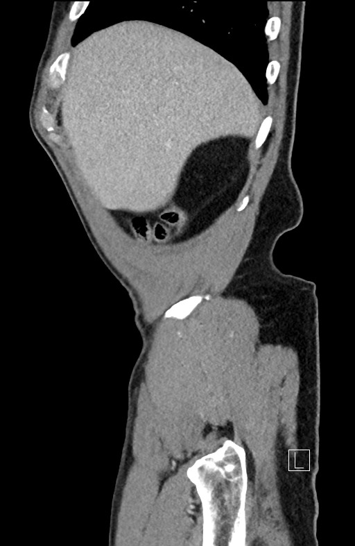 Closed loop small bowel obstruction - internal hernia (Radiopaedia 57806-64778 C 98).jpg