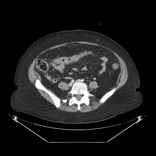 Closed loop small bowel obstruction - internal hernia (Radiopaedia 65402-74450 A 85).jpg