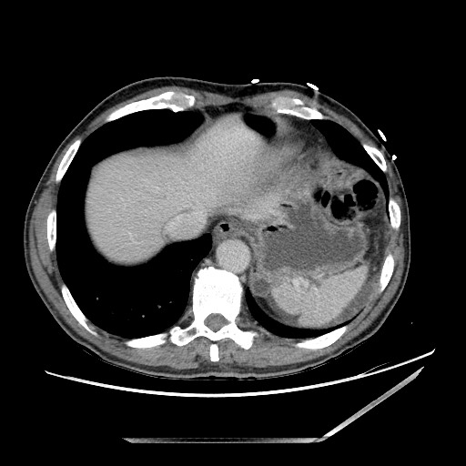 Closed loop small bowel obstruction - omental adhesion causing "internal hernia" (Radiopaedia 85129-100682 A 17).jpg