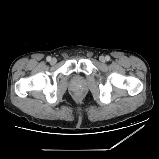 Closed loop small bowel obstruction - omental adhesion causing "internal hernia" (Radiopaedia 85129-100682 A 171).jpg