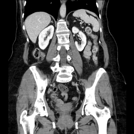 Closed loop small bowel obstruction due to adhesive bands - early and late images (Radiopaedia 83830-99014 B 81).jpg
