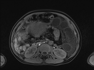 Closed loop small bowel obstruction in pregnancy (MRI) (Radiopaedia 87637-104031 Axial T1 fat sat 57).jpg