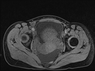 Closed loop small bowel obstruction in pregnancy (MRI) (Radiopaedia 87637-104031 F 60).jpg