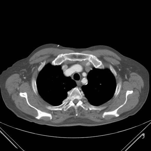 File:Coarctation of the aorta (Radiopaedia 17427-17116 B 12).jpg