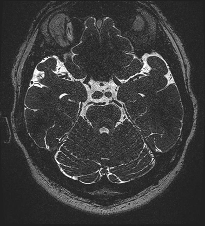 Cochlear incomplete partition type III associated with hypothalamic hamartoma (Radiopaedia 88756-105498 Axial T2 127).jpg