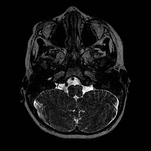 File:Cochlear nerve aplasia - unilateral (Radiopaedia 87910-104413 Axial T2 6).jpg