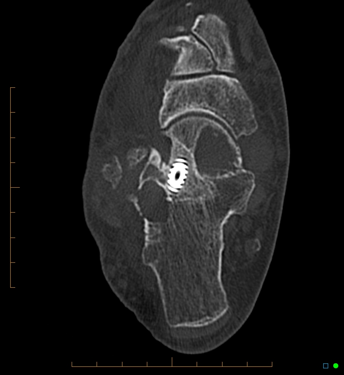 Collapsed total ankle replacement (Radiopaedia 17228-16932 Axial bone window 50).jpg