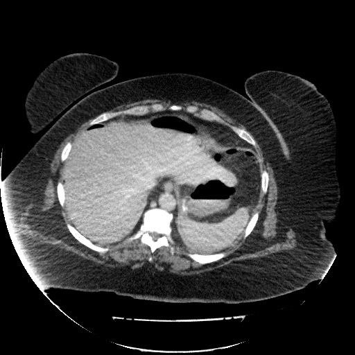 File:Collection due to leak after sleeve gastrectomy (Radiopaedia 55504-61972 A 16).jpg