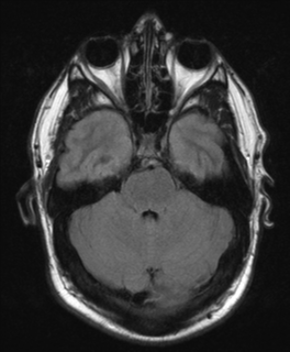 File:Colloid cyst (Radiopaedia 44510-48181 Axial FLAIR 8).png