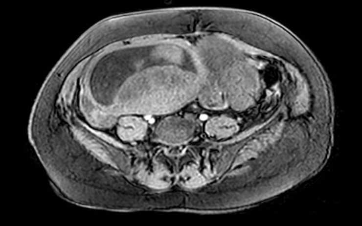 Colon adenocarcinoma with Krukenberg tumors, advanced pregnancy (Radiopaedia 67279-76645 A 31).jpg
