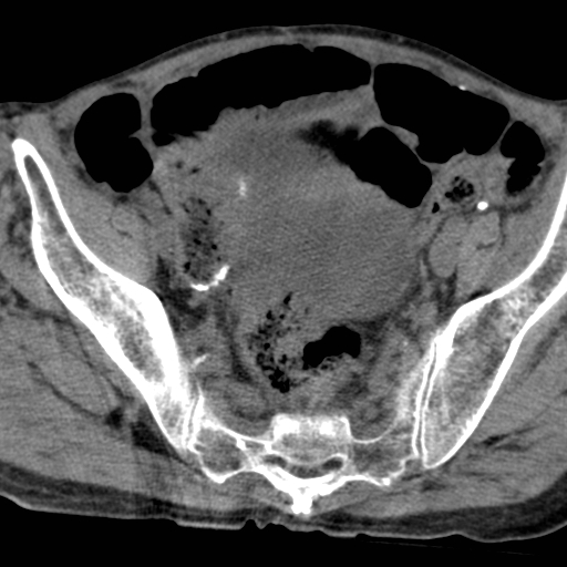 File:Colon cancer with calcified liver metastasis (Radiopaedia 74423-85309 Axial non-contrast 94).jpg