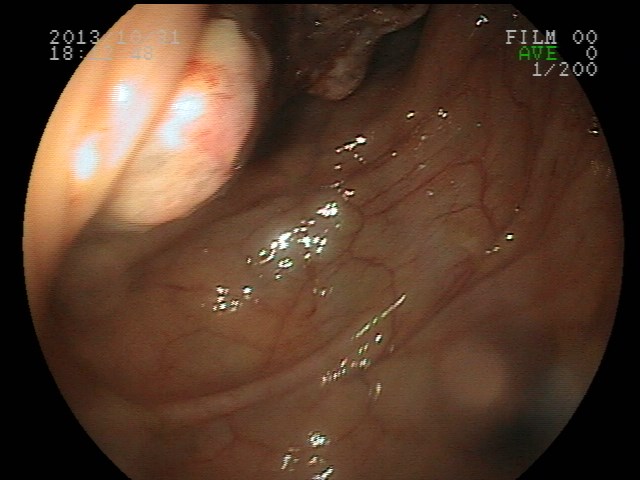 File:Colon carcinoma (Radiopaedia 27713-27927 E 1).jpg