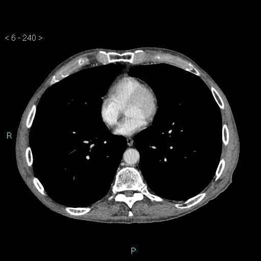 Colonic cancer (ultrasound and TC imaging) (Radiopaedia 50346-55713 B 240).jpg
