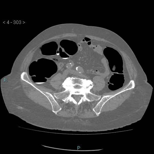 Colonic lipomas (Radiopaedia 49137-54244 Axial bone window 135).jpg