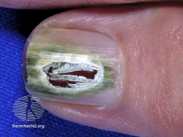 File:Green nail due to pseudomonas infection (DermNet NZ green-nail2).jpg