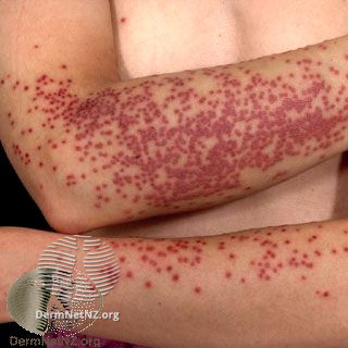 File:Herpes simplex (DermNet NZ 2857).jpg