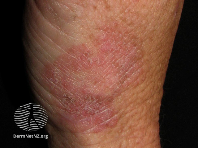 Intraepidermal carcinoma (DermNet NZ lesions-scc-in-situ-2966).jpg