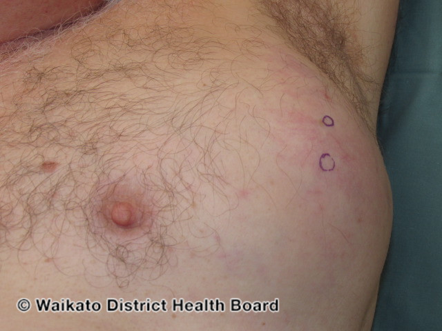 File:Metastatic melanoma (DermNet NZ metastatic-melanoma-03).jpg