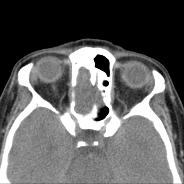 Nasolabial cyst (Radiopaedia 33987-35205 Axial non-contrast 39).jpg