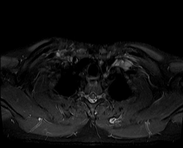 File:Nasopharyngeal carcinoma with perineural spread (Radiopaedia 55030-61380 Axial STIR 1).jpg