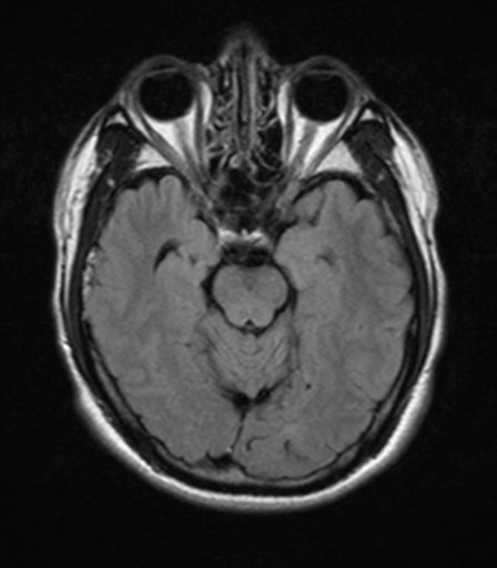 File:Nasopharyngeal carcinoma with pterygopalatine fossa involvement (Radiopaedia 33102-34134 Axial FLAIR 9).png