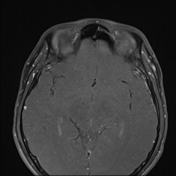 Nasopharyngeal carcinoma with skull base invasion (Radiopaedia 53415-59485 Axial T1 C+ fat sat 11).jpg