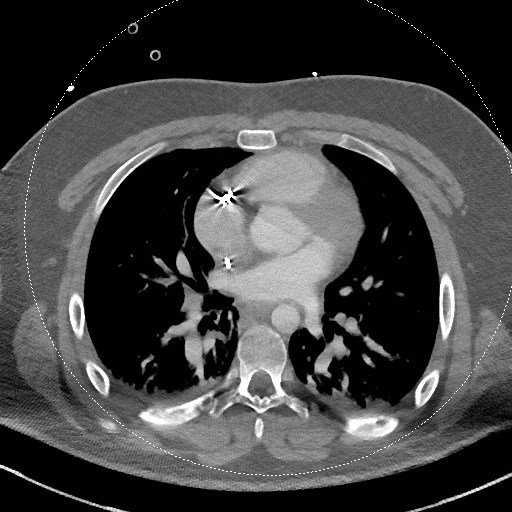 File:Neck CT angiogram (intraosseous vascular access) (Radiopaedia 55481-61945 B 3).jpg