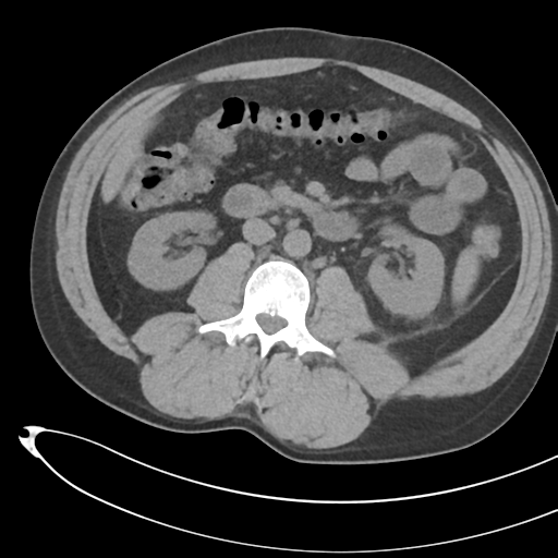File:Necrotizing pancreatitis with acute necrotic collections (Radiopaedia 38829-41012 Axial non-contrast 41).png