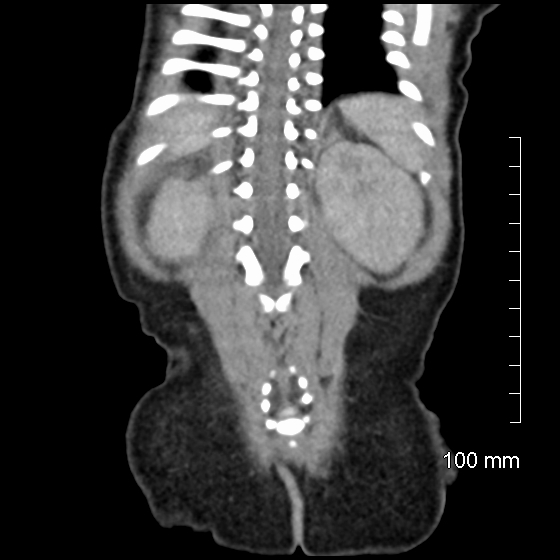 File:Neonatal neuroblastoma (Radiopaedia 56651-63438 Coronal non-contrast 42).jpg