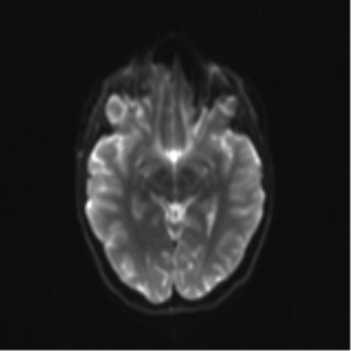 Neurenteric cyst (Radiopaedia 58641-65837 Axial DWI 17).png