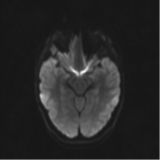 Neurenteric cyst (Radiopaedia 58641-65837 Axial DWI 50).png