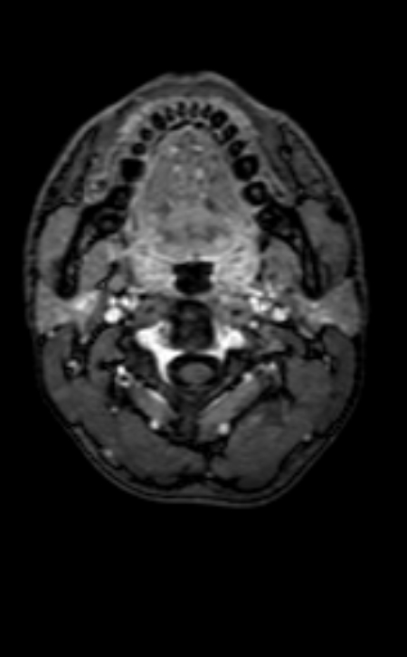 Neuro-Behçet disease (Radiopaedia 90112-107294 Axial T1 C+ 231).jpg