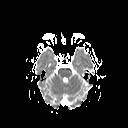 File:Neuro-Behcet's disease (Radiopaedia 21557-21505 Axial ADC 7).jpg