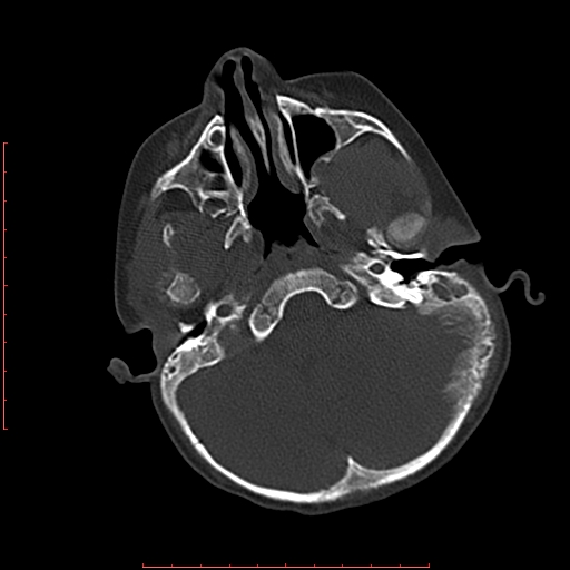 File:Neuroblastoma skull metastasis (Radiopaedia 56053-62683 Axial bone window 6).jpg