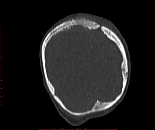 File:Neuroblastoma skull metastasis (Radiopaedia 56053-62683 Coronal bone window 38).jpg